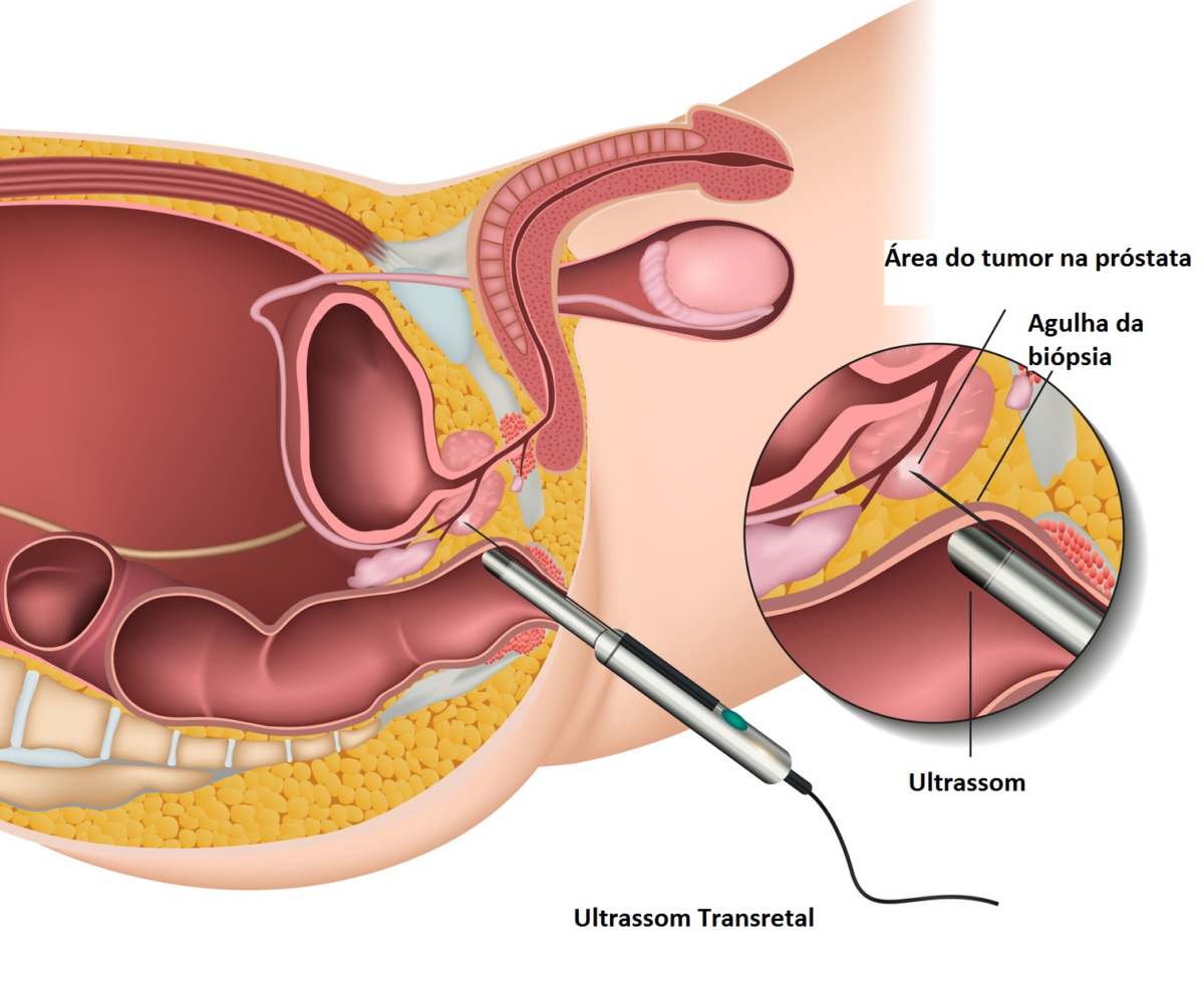 tipos de biópsia da próstata curcuma et prostatite