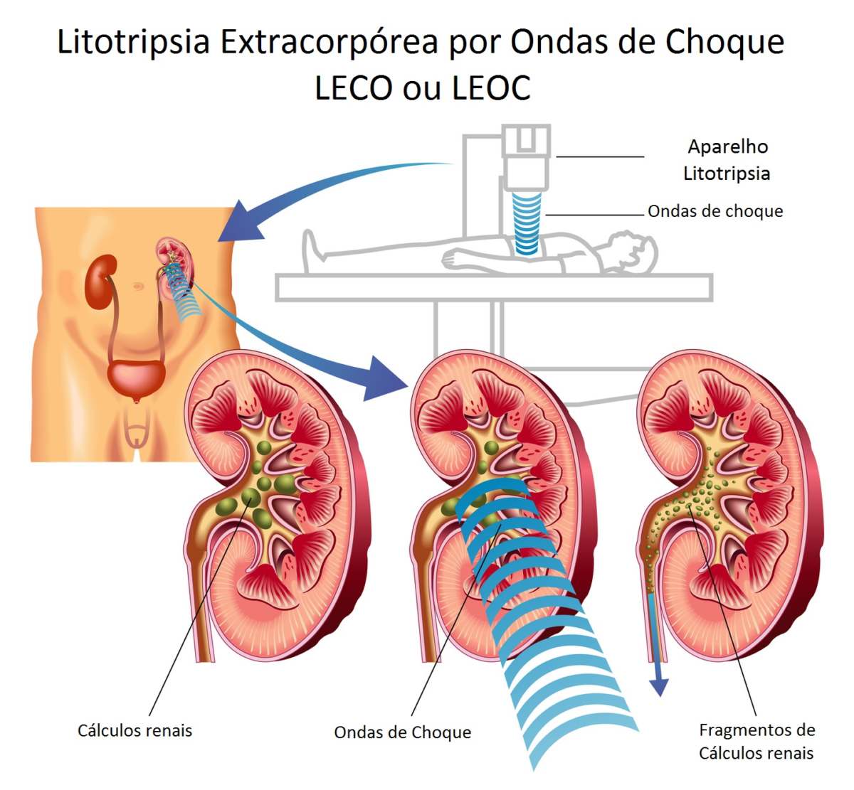 infográfico de litotripsia extracorpórea